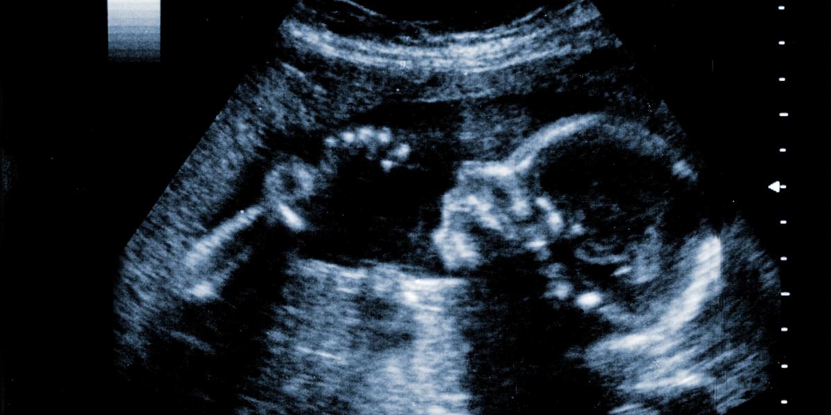 Ultrasound image of a fetus